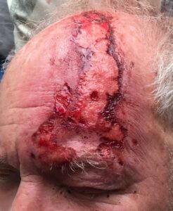 Herpes Zoster Ophthalmicus (HZO)- and Post Herpetic Neuralgia (PHN)